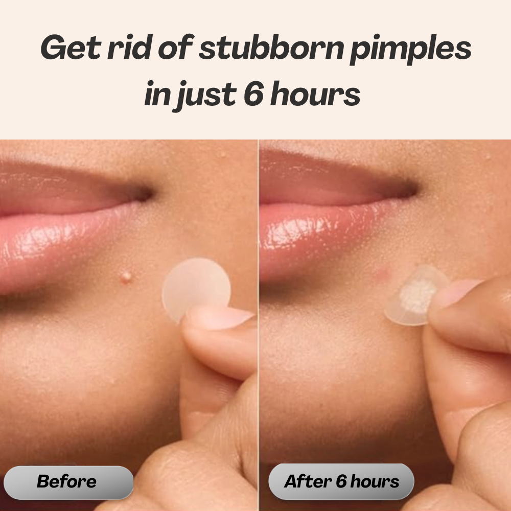 Acne Patches